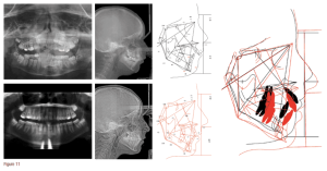 Phân tích case: Răng mọc chen chúc nghiêm trọng cùng với sự bất tương quan xương theo chiều ngang ảnh hưởng đến lòng tự trọng của bệnh nhân