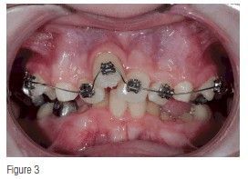 Phân tích case: Răng mọc chen chúc nghiêm trọng cùng với sự bất tương quan xương theo chiều ngang ảnh hưởng đến lòng tự trọng của bệnh nhân