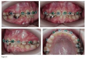 Phân tích case: Răng mọc chen chúc nghiêm trọng cùng với sự bất tương quan xương theo chiều ngang ảnh hưởng đến lòng tự trọng của bệnh nhân