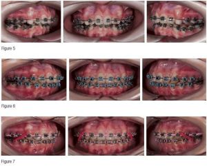 Phân tích case: Răng mọc chen chúc nghiêm trọng cùng với sự bất tương quan xương theo chiều ngang ảnh hưởng đến lòng tự trọng của bệnh nhân