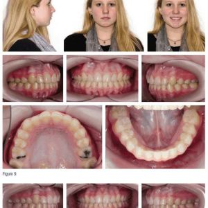 Phân tích case: Răng mọc chen chúc nghiêm trọng cùng với sự bất tương quan xương theo chiều ngang ảnh hưởng đến lòng tự trọng của bệnh nhân