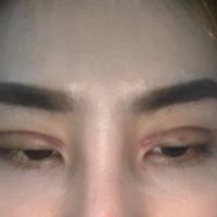 Sẹo sau cắt mí có tự hết không