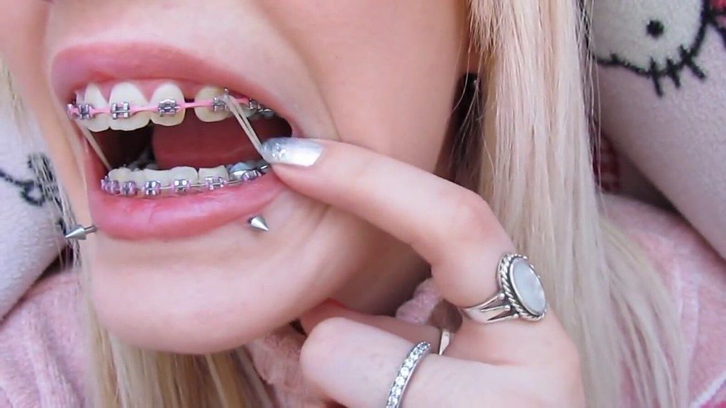 thun kéo liên hàm