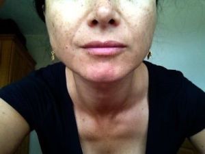 Tôi đã tiêm botox góc hàm được 2 ngày, khoảng bao lâu sau thì thấy kết quả?