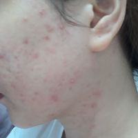 NÊN DÙNG SẢN PHẨM GÌ TRỊ MỤN CHO DA NHẠY CẢM? NÊN DÙNG SẢN PHẨM GÌ TRỊ MỤN CHO DA NHẠY CẢM?