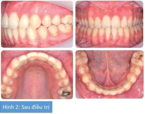 Phân tích case: Phẫu thuật hàm kết hợp niềng răng cho bệnh nhân nữ bị cắn hở 12 mm