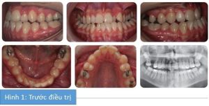 Phân tích case: Niềng răng kết hợp phẫu thuật hàm cho bệnh nhân bị móm, lệch đường giữa, răng chen chúc