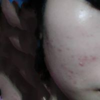 Làm sao để kiềm dầu, hết mụn, hết thâm?