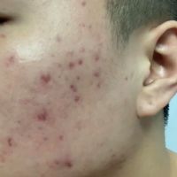 Giới thiệu mĩ phẩm trị thâm sau mụn? Giới thiệu mĩ phẩm trị thâm sau mụn?