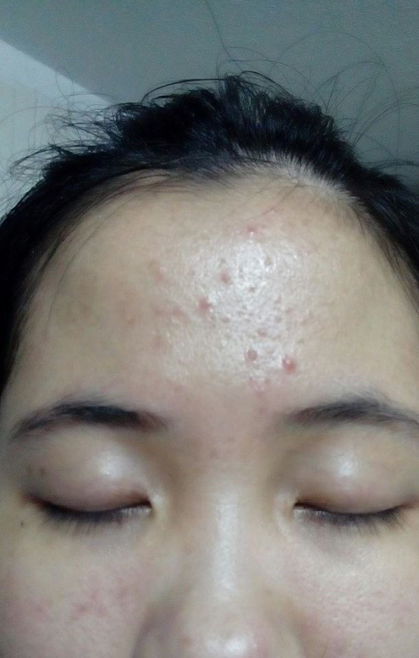 Chăm sóc da mùa nóng để không bị lên mụn?