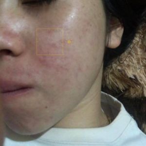 Tư vấn cho da nhạy cảm, lỗ chân lông to, tàn nhang