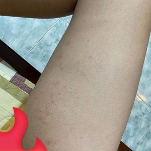 Cách khắc phục tình trạng mụn và ngứa sau khi đi triệt lông?