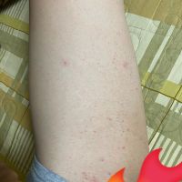 Cách khắc phục tình trạng mụn và ngứa sau khi đi triệt lông?