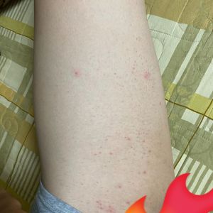 Cách khắc phục tình trạng mụn và ngứa sau khi đi triệt lông?