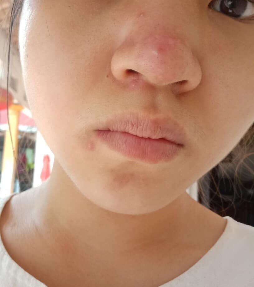 Dùng chấm mụn nào hiệu quả?