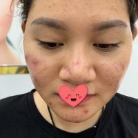 Trị mụn viêm mủ mãi không khỏi phải làm gì? Trị mụn viêm mủ mãi không khỏi phải làm gì?