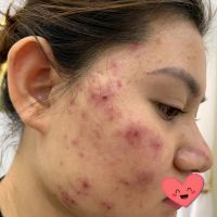 Trị mụn viêm mủ mãi không khỏi phải làm gì? Trị mụn viêm mủ mãi không khỏi phải làm gì?