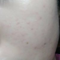 Làm sao để kiềm dầu, hết mụn, hết thâm?