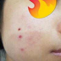 Khắc phục tình trạng sẹo sau khi tẩy nốt ruồi? Khắc phục tình trạng sẹo sau khi tẩy nốt ruồi?