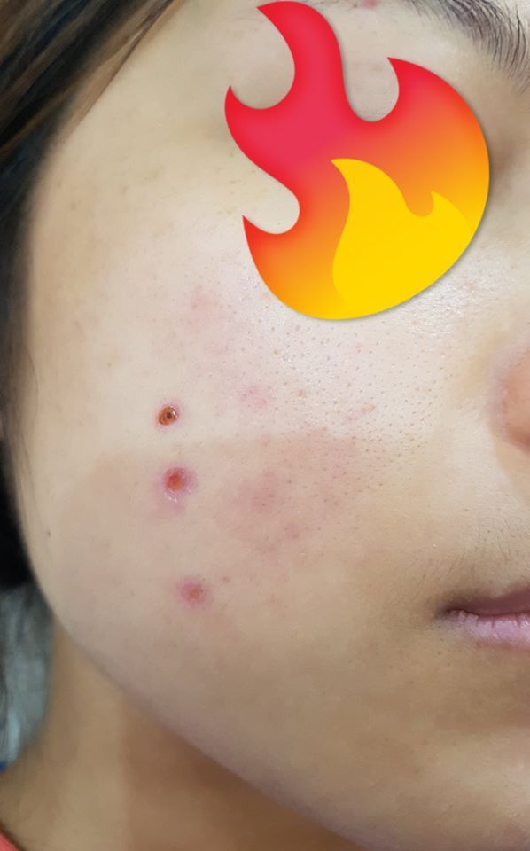 Khắc phục tình trạng sẹo sau khi tẩy nốt ruồi? Khắc phục tình trạng sẹo sau khi tẩy nốt ruồi?