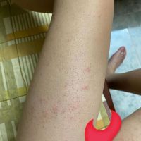 Cách khắc phục tình trạng mụn và ngứa sau khi đi triệt lông?