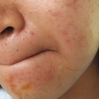 Nên dùng thêm gì cho da hết mụn?