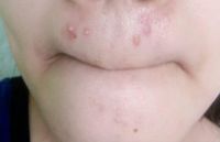 Làm sao để hết mụn? Làm sao để hết mụn?