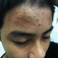 Vùng trán đầy mụn phải làm sao? Vùng trán đầy mụn phải làm sao?