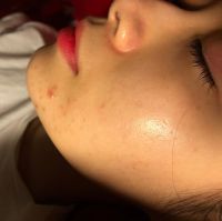 Giới thiệu mĩ phẩm trị thâm sau mụn? Giới thiệu mĩ phẩm trị thâm sau mụn?