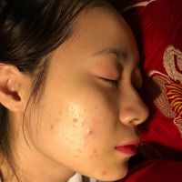 Đang dùng sản phẩm trị mụn có nên uống thêm viên mát gan không?