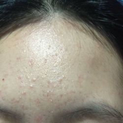Làm sao để kiềm dầu, hết mụn, hết thâm?