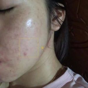 Tư vấn cho da nhạy cảm, lỗ chân lông to, tàn nhang