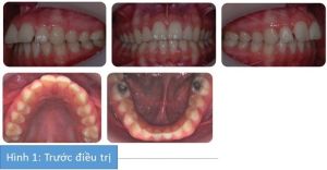 Phân tích case: Niềng răng kết hợp phẫu thuật cho bệnh nhân nữ bị hô, có tật mút môi