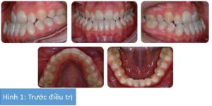 Phân tích case: Chỉnh nha phẫu thuật cho bệnh nhân 17 tuổi đã từng nhổ bỏ răng khi điều trị trước kia
