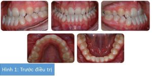 Phân tích case: Chỉnh nha phẫu thuật cho bệnh nhân 17 tuổi đã từng nhổ bỏ răng khi điều trị trước kia