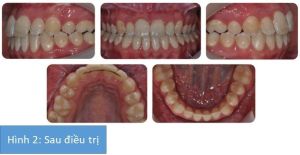 Phân tích case: Chỉnh nha phẫu thuật cho bệnh nhân 17 tuổi đã từng nhổ bỏ răng khi điều trị trước kia