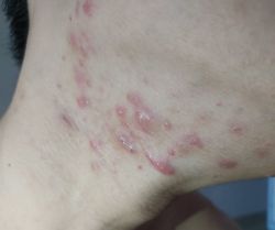 Xin kinh nghiệm chữa trị mụn vùng cổ