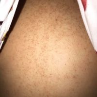 Xử lý mụn lấm tấm ở lưng thế nào?