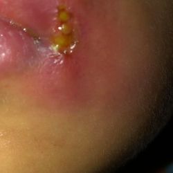 Cách chữa trị mụn mủ ở khóe miệng?