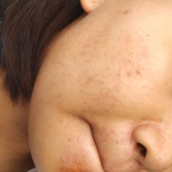 Nên dùng thêm gì cho da hết mụn?