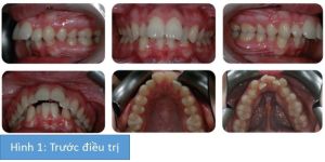 Phân tích case: Niềng răng và phẫu thuật kéo giãn xương hàm dưới cho bệnh nhân bị hô đáng kể