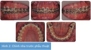 Phân tích case: Niềng răng kết hợp phẫu thuật cho bệnh nhân nữ bị hô, có tật mút môi