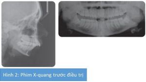 Phân tích case: Niềng răng và phẫu thuật kéo giãn xương hàm dưới cho bệnh nhân bị hô đáng kể