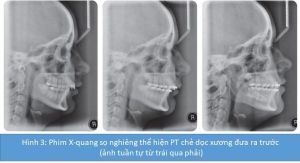 Phân tích case: Niềng răng kết hợp phẫu thuật cho bệnh nhân nữ bị hô, có tật mút môi