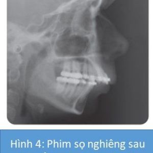 Phân tích case: Niềng răng và phẫu thuật kéo giãn xương hàm dưới cho bệnh nhân bị hô đáng kể
