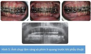 Phân tích case: Niềng răng và phẫu thuật kéo giãn xương hàm dưới cho bệnh nhân bị hô đáng kể