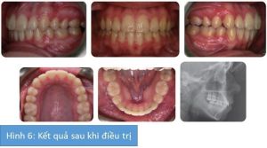 Phân tích case: Niềng răng và phẫu thuật kéo giãn xương hàm dưới cho bệnh nhân bị hô đáng kể