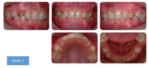 Phân tích case: Niềng răng thành công cho bệnh nhân 10 tuổi có các răng số 5 mọc ngầm và R21 chết tủy