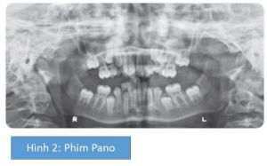 Phân tích case: Niềng răng thành công cho bệnh nhân 10 tuổi có các răng số 5 mọc ngầm và R21 chết tủy