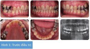 Phân tích case: Niềng răng, phẫu thuật hàm và phẫu thuật làm nhỏ cằm cho khách hàng nữ 42 tuổi